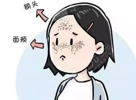 激光祛黃褐斑反多久可以恢復(fù)