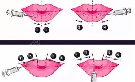 非手術(shù)豐唇方法有哪些