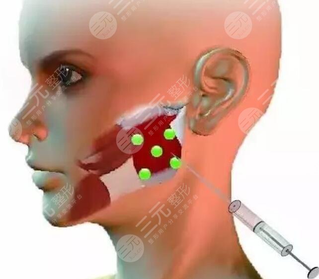 注射瘦臉副作用