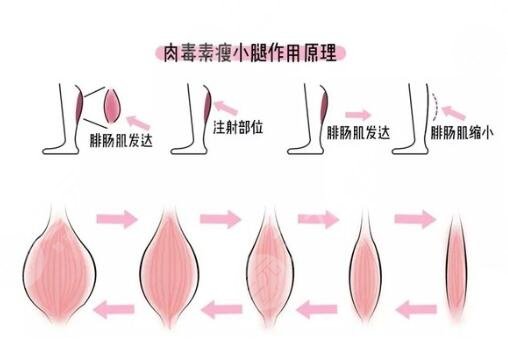 進口注射瘦臉能瘦小腿嗎
