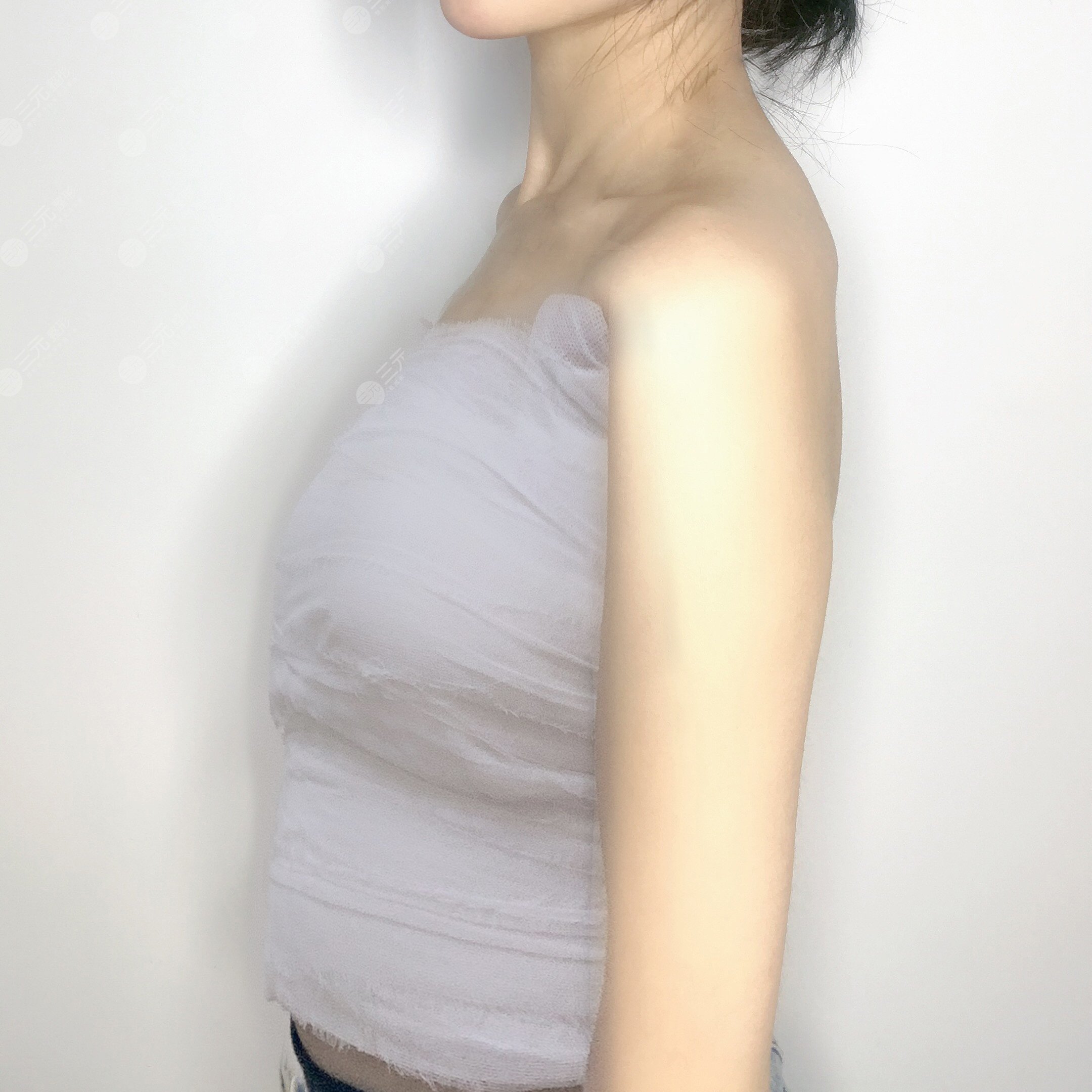 乳房縮小術(shù)前后對(duì)比,看了你就相信杭州美來比較好!