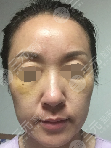 面部年輕化plus全臉，快速解決面部問題，內(nèi)附真實案例分享圖