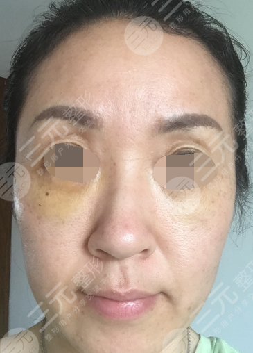 面部年輕化plus全臉，快速解決面部問題，內(nèi)附真實案例分享圖