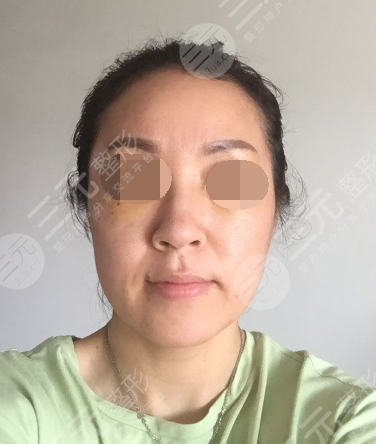 面部年輕化plus全臉，快速解決面部問題，內(nèi)附真實案例分享圖