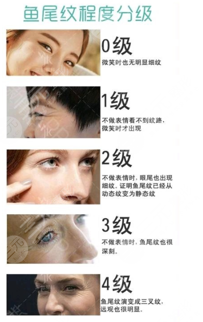 魚尾紋怎么去除