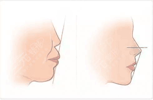 齙牙怎么矯正？如何解決齙牙這個問題，成為了他們的重中之重
