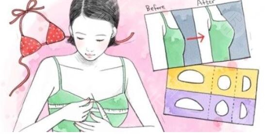 北京假體隆胸真人案例大分享，豐胸果看得見