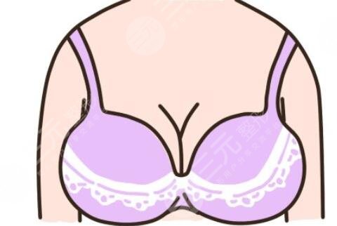 平胸妹假體隆胸手術案例分享，果肉眼可見