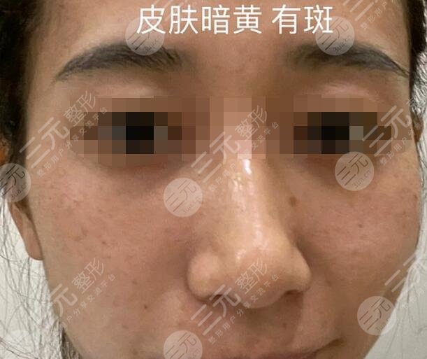 九江附屬醫(yī)院整形科激光祛斑前