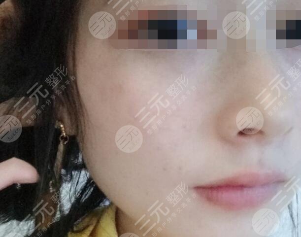 九江附屬醫(yī)院整形科激光祛斑后