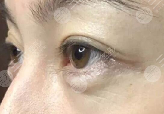 激光去魚尾紋案例前