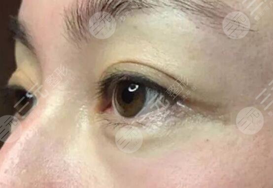 激光去魚尾紋案例后