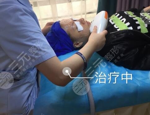 激光去魚尾紋案例中