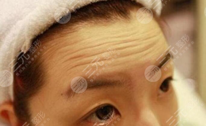 去抬頭紋大概要多少錢？深知4個原因影響了手術(shù)的價格！