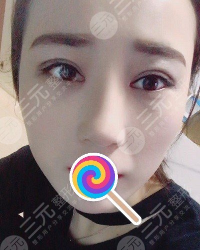 九院韋敏綜合鼻案例