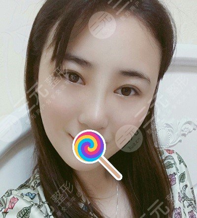 九院韋敏綜合鼻案例