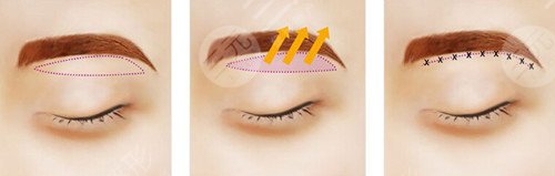 提眉術(shù)價格一般是多少