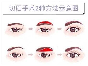 提眉術(shù)價格一般是多少