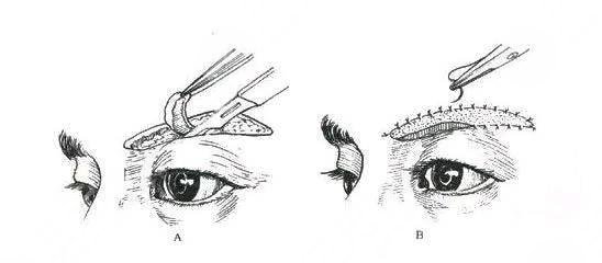 提眉術(shù)價格一般是多少
