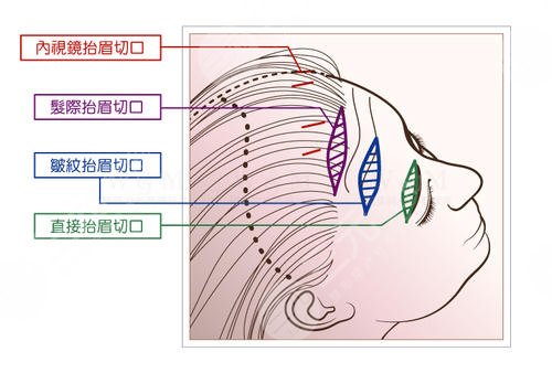 提眉術(shù)價格一般是多少