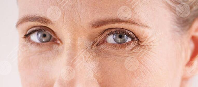 面部除皺|魚尾紋怎么去除？讓心靈之窗綻放“睛”彩