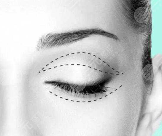 植眉注意事項(xiàng)