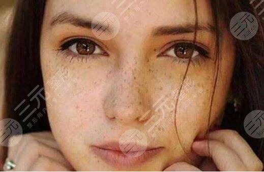 激光祛黃褐斑果如何