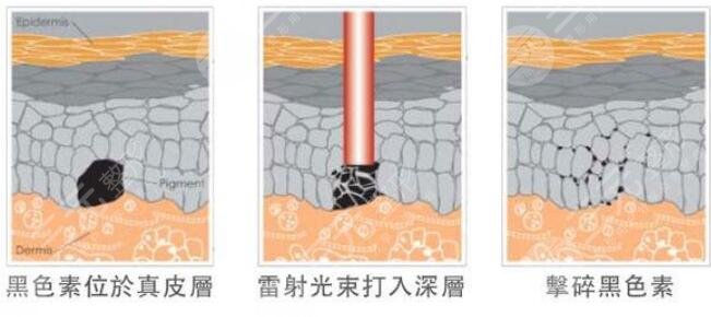 激光祛黃褐斑后的注意事項(xiàng)