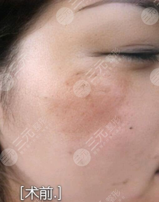 黃褐斑緩解前