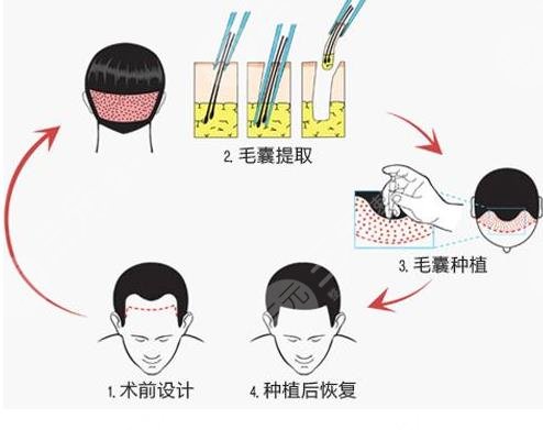 植發(fā)后會脫落嗎?植發(fā)能夠維持多久呢?