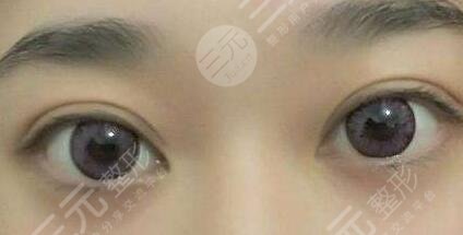 韓式or歐式雙眼皮合適更好