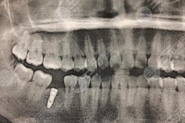 廈門(mén)市口腔醫(yī)院種植牙手術(shù)經(jīng)歷分享