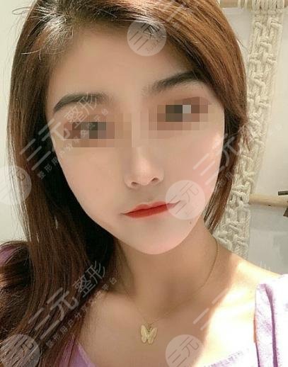 黑臉娃娃嫩膚后2個月