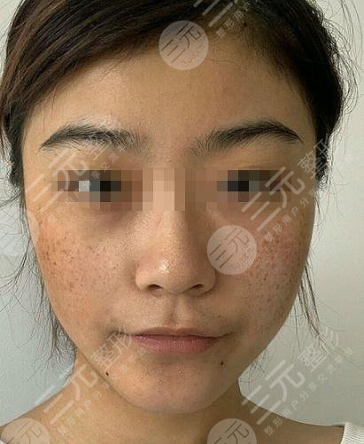 黑臉娃娃嫩膚前