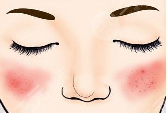 臉上紅血絲如何去除？怎么修復(fù)？