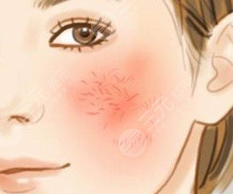 臉上紅血絲如何去除？怎么修復(fù)？