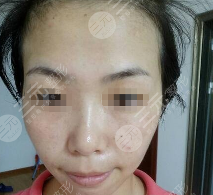 九院激光pm激光祛斑價(jià)格