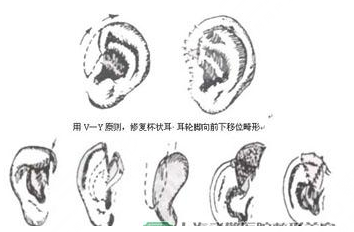 杯狀耳矯正器價格