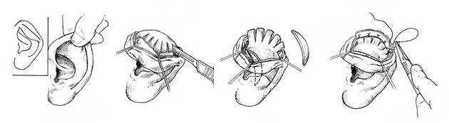 杯狀耳矯正多少錢