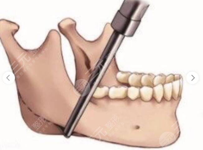 磨下頜骨多久能笑
