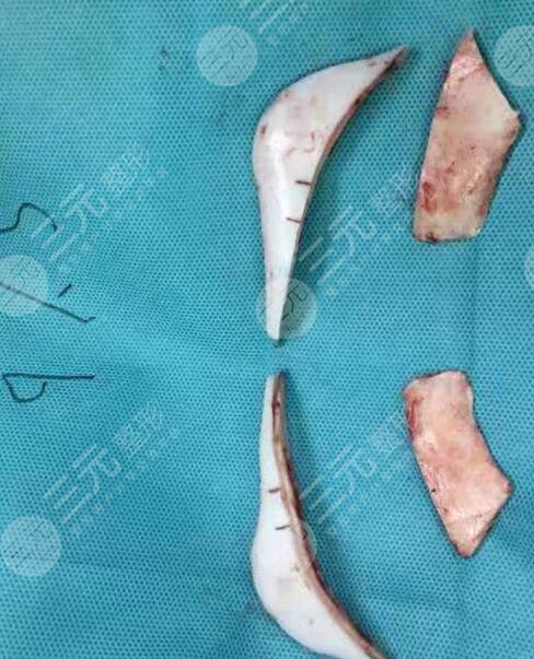 磨下頜骨手術術前注意事項介紹