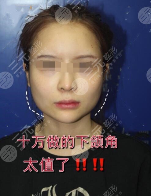 磨下頜骨手術術前