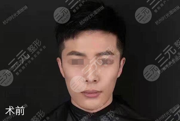 網(wǎng)紅圈都在做的顱耳角在30°-60°之間整形前