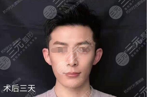 網(wǎng)紅圈都在做的顱耳角在30°-60°之間整形后