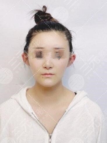 顱耳角在30°-60°之間整形后