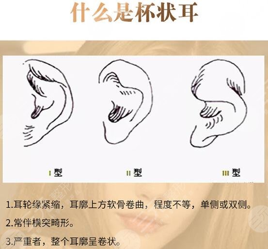 杯狀耳矯正好的年齡