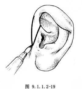 杯狀耳矯正器價格