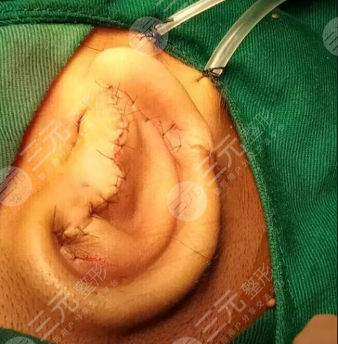 郭樹忠再造耳費用