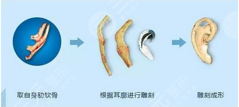 郭樹忠再造耳費用