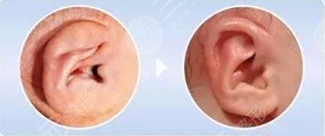 郭樹忠再造耳費用